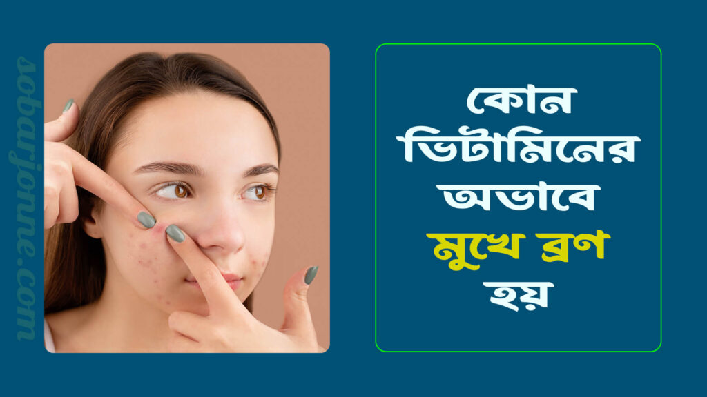 কোন ভিটামিনের অভাবে মুখে ব্রণ হয় 1024x576