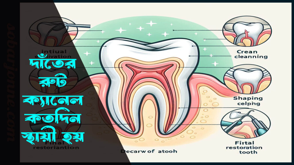 দাঁতের রুট ক্যানেল কতদিন স্থায়ী হয় এবং রুট ক্যানেল করলে কত খরচ হতে পারে রুট ক্যানেল কতদিন স্থায়ী হয় 0 1024x576