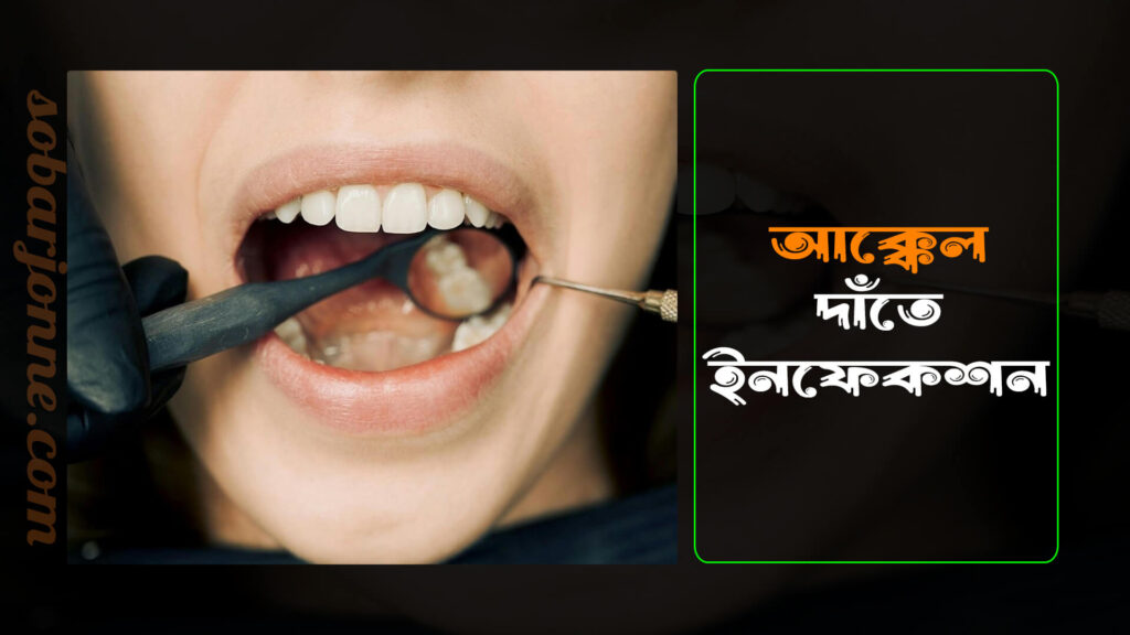 আক্কেল দাঁতে ইনফেকশন 0 1024x576