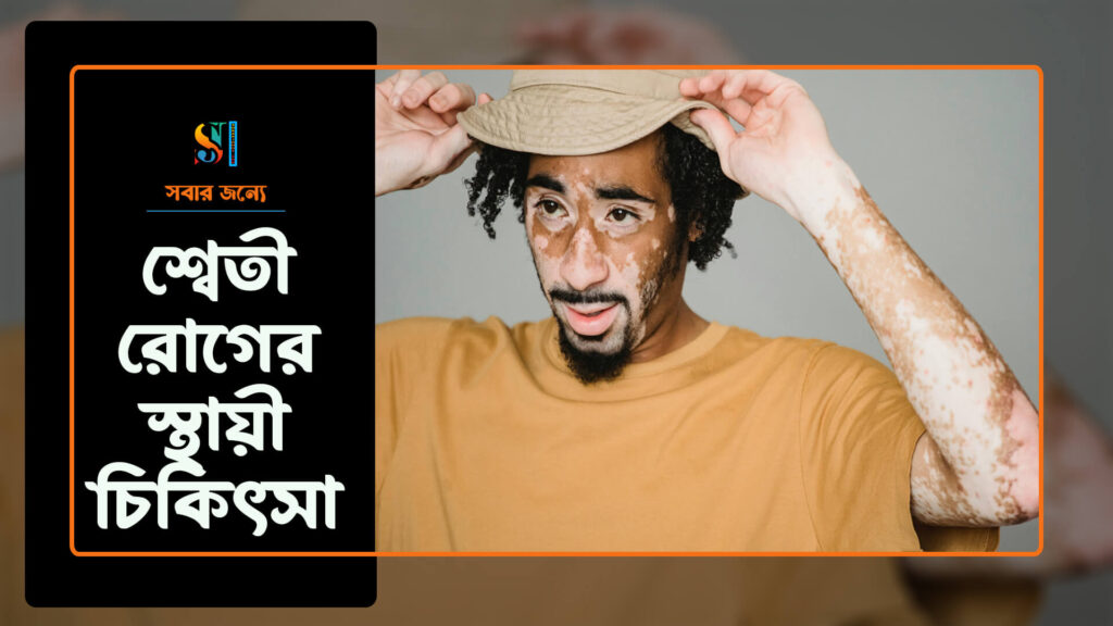 শ্বেতী রোগের স্থায়ী চিকিৎসা 1024x576